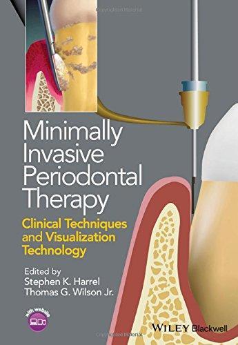 skihosevx: Minimally Invasive Periodontal Therapy Clinical Techniques And Visualization Technology - skihosevxskihosevx: Minimally Invasive Periodontal Therapy Clinical Techniques And Visualization TechnologyE-booksskihosevxskihosevxBSL-V2-8436E-books